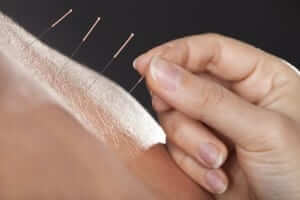 Close-up Of A Hand Placing Acupuncture Needle On Person's Back