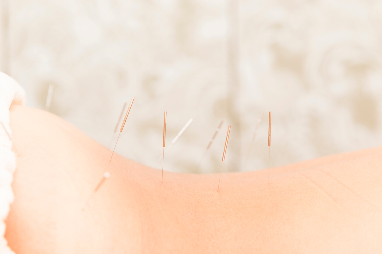 Acupuncture to the waist of oriental women