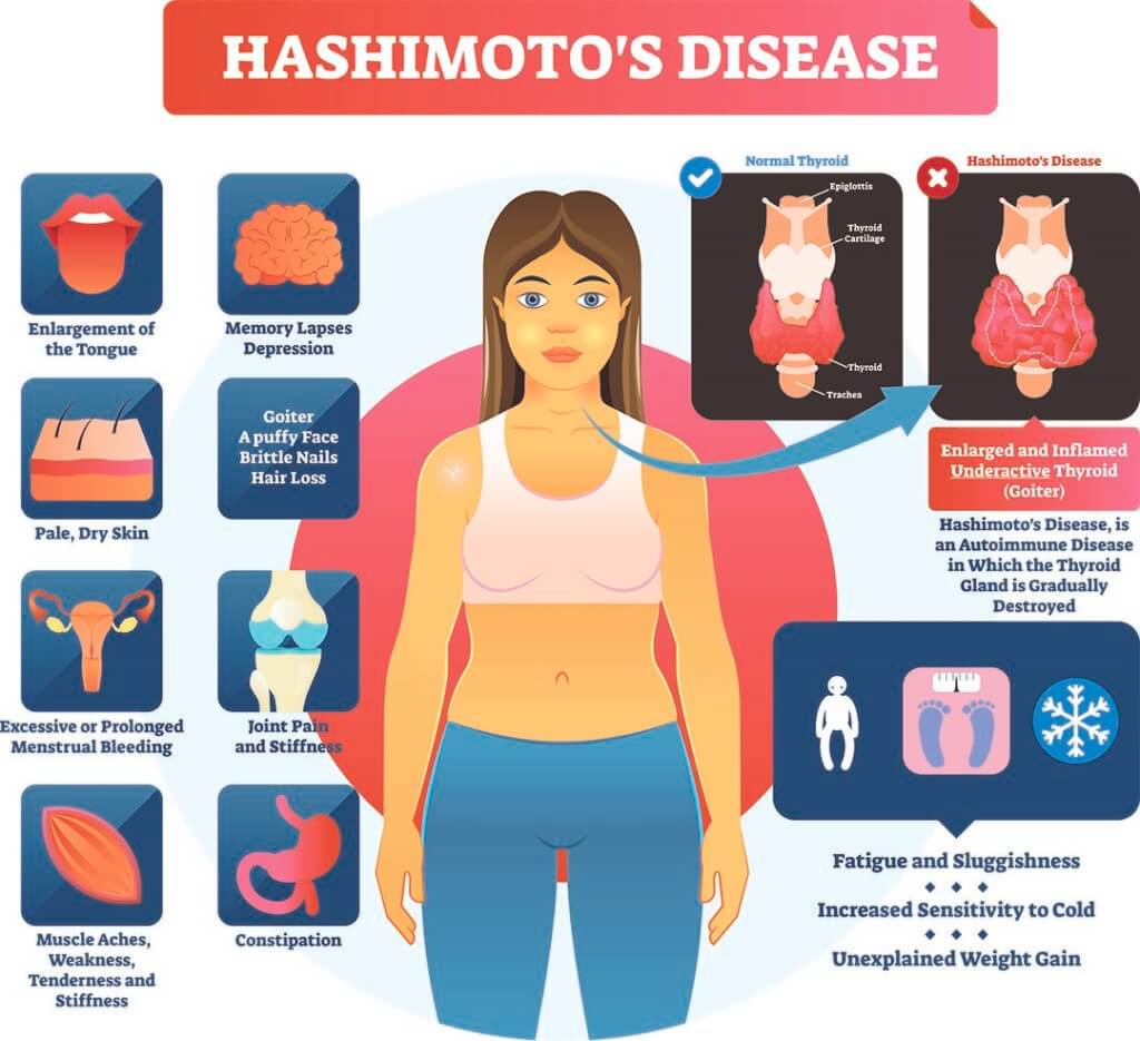 Symptoms of Hashimoto’s Syndrome