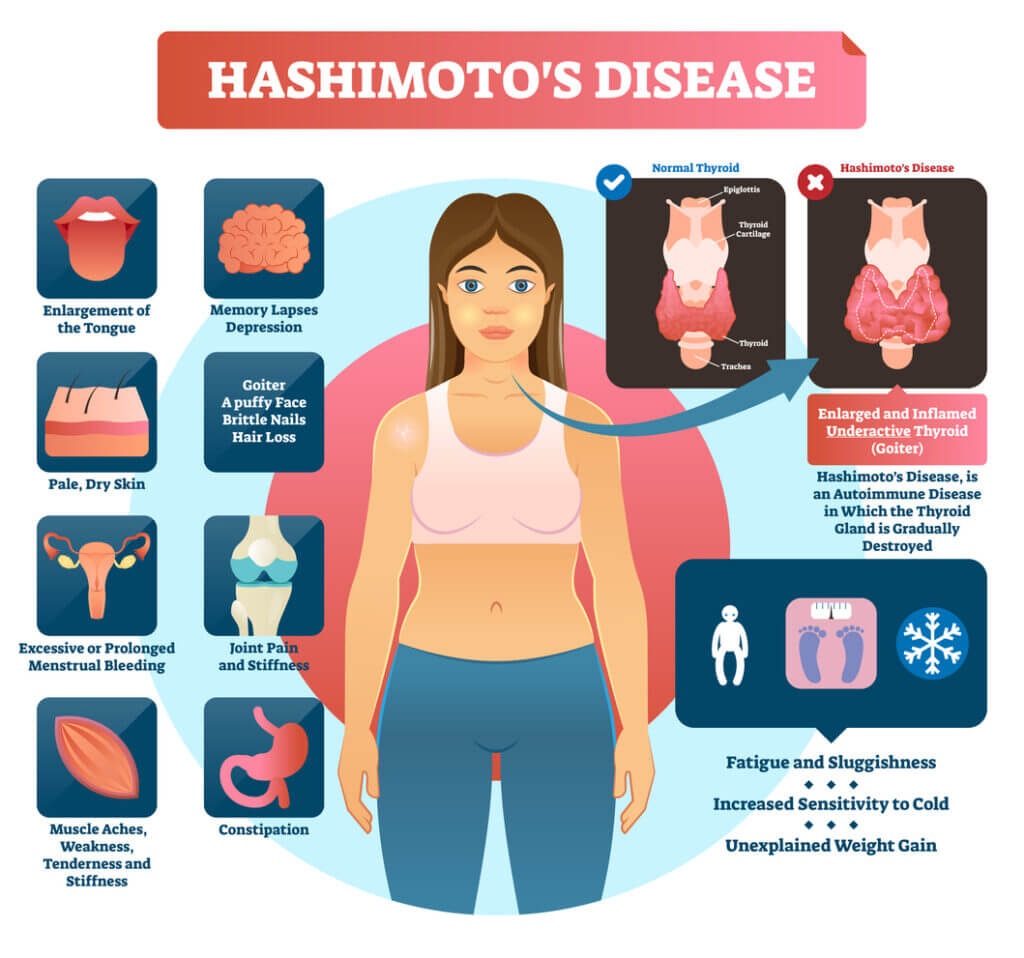 Hashimotos AutoImmune Disease