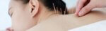 top 10 benefits of acupuncture